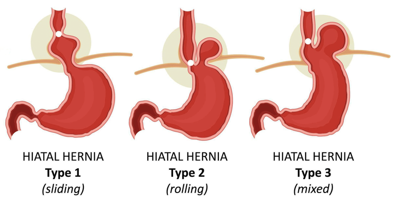 thoát vị khe hoành