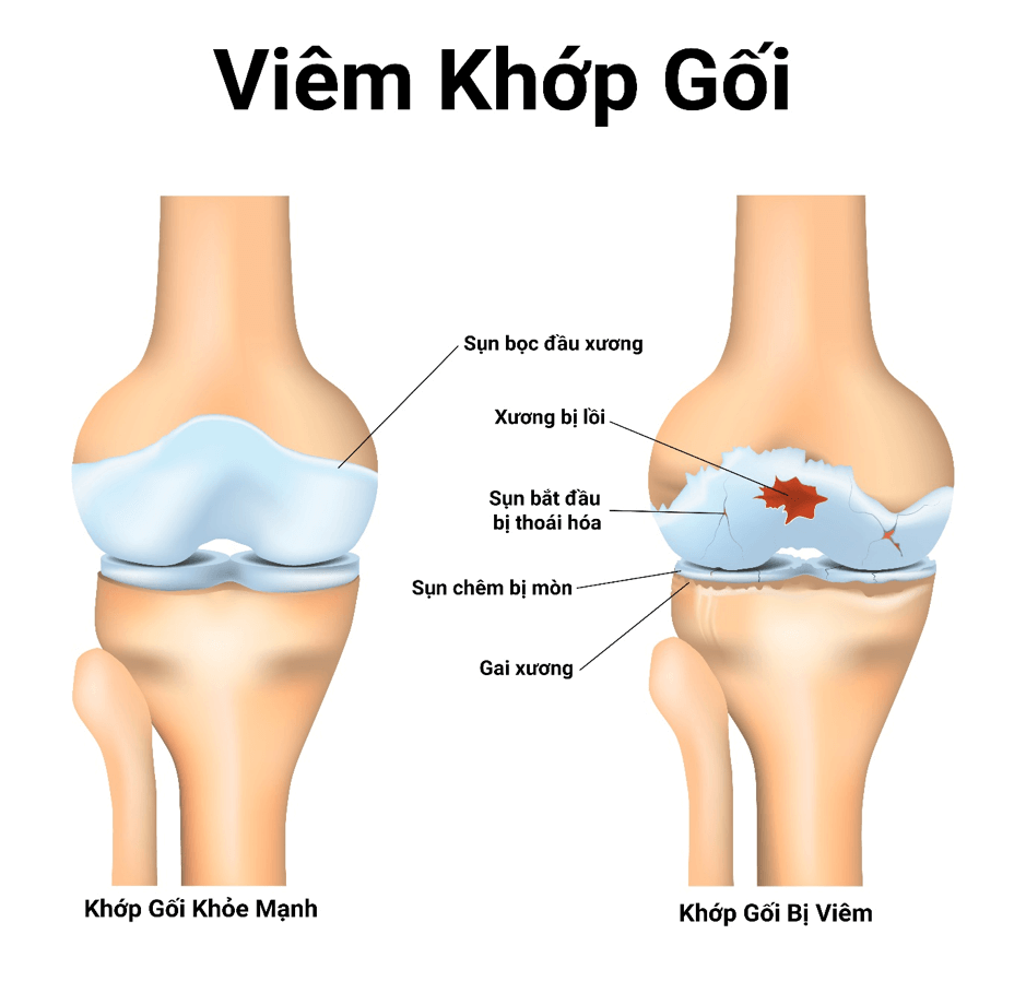 bệnh thường gặp ở khớp gối