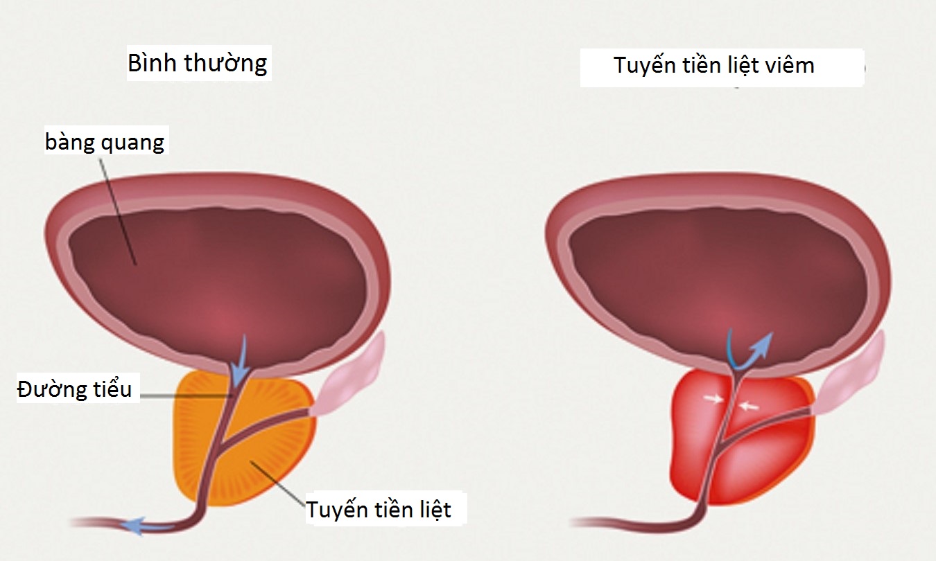bệnh viêm tuyến tiền liệt