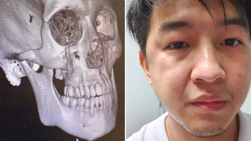 chẩn đoán gãy xương gò má