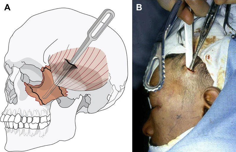 phẫu thuật gãy xương gò má