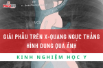 Hiểu Biết Giải Phẫu Trên X-Quang Ngực Thẳng: Chìa Khóa Chẩn Đoán Hình Ảnh Y Khoa