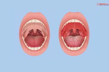 Giải Phẫu Amidan: Vị trí, Cấu Tạo, Chức Năng Và Bệnh Lý Thường Gặp